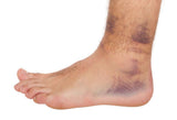 ATOMIC BALM 1 Oz to help heal sprained ankles and injuries in record time. Pain relief balm treats all kind of foot and ankle pain, including plantar fasciitis.